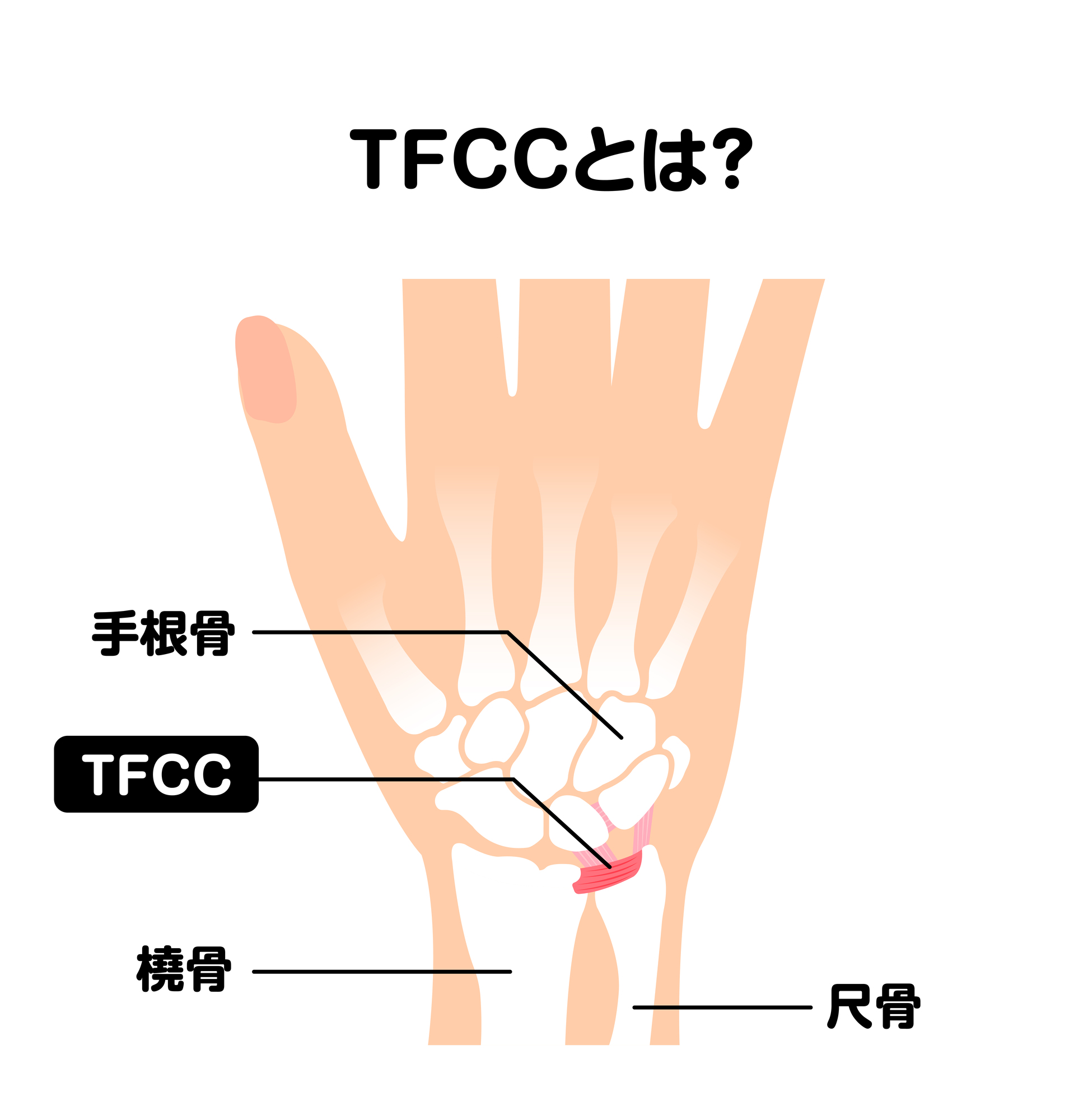 手首に加わる力を調節してくれる「TFCC」とは