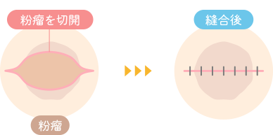 切開法（炎症が強い場合に適用）