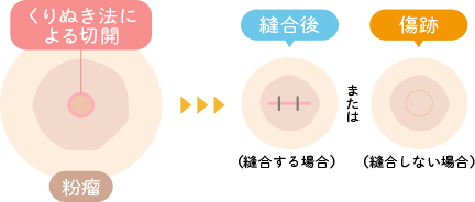 くり抜き法（小さな傷で済む）